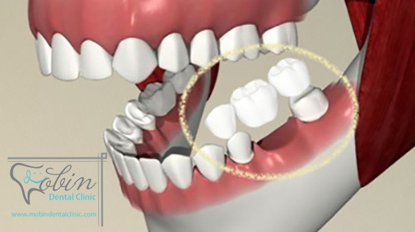 بریج دندان چیست و تفاوت آن با ایمپلنت